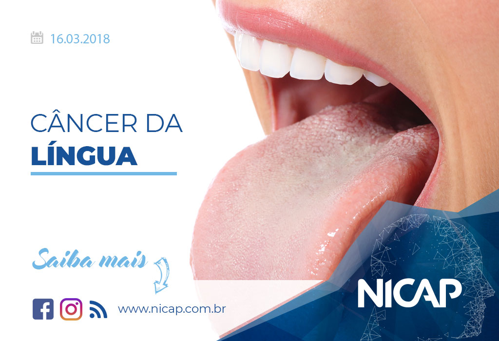 Câncer da língua: sintomas, diagnóstico e tratamento - NICAP