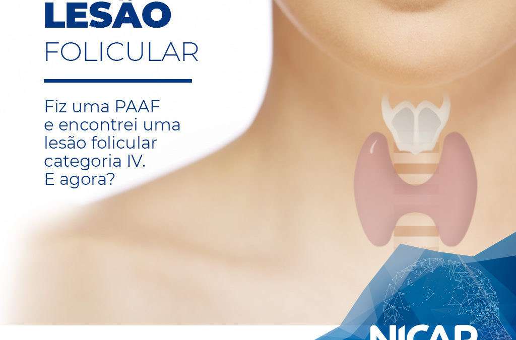 Fiz uma PAAF e encontrei uma lesão folicular categoria IV. E agora?